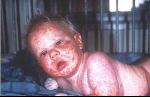 The effects of Smallpox vaccine - WARNING graphic photos