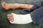 1.) burst vein and crushed ankle put in plaster