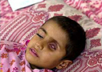 This 4-year-old Iraqi boy is suffering from a tumor growing in his eye.Photo:BBC