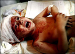 Injured child