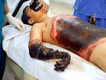 Examination of this picture shows Ali Abbas was subjected to radiated heat