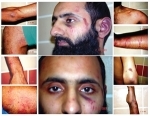 Some of Babars Injuries post police assault in December 2003
