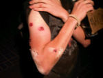 Photos of rubber bullet wounds from police shooting 21 year old out of tree