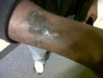 An injury on Daniel's arm from a previous deportation attempt in 2008