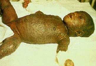 The effects of Smallpox vaccine - WARNING graphic photos
