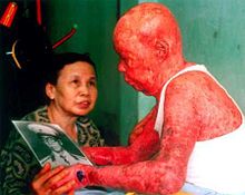 Major Tự Đức Phang was exposed to dioxin-contaminated Agent Orange
